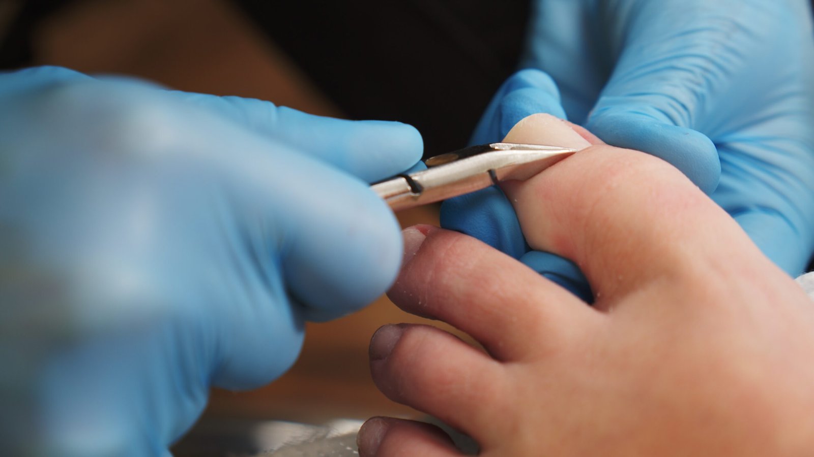Fußpflege an einem Zeh mit Metallinstrument und medizinischen Handschuhen